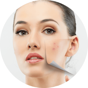 טיפולי אקנה